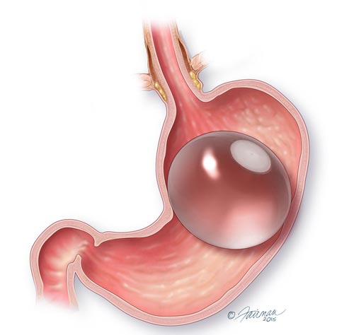 Image of the gastric balloon in the stomach